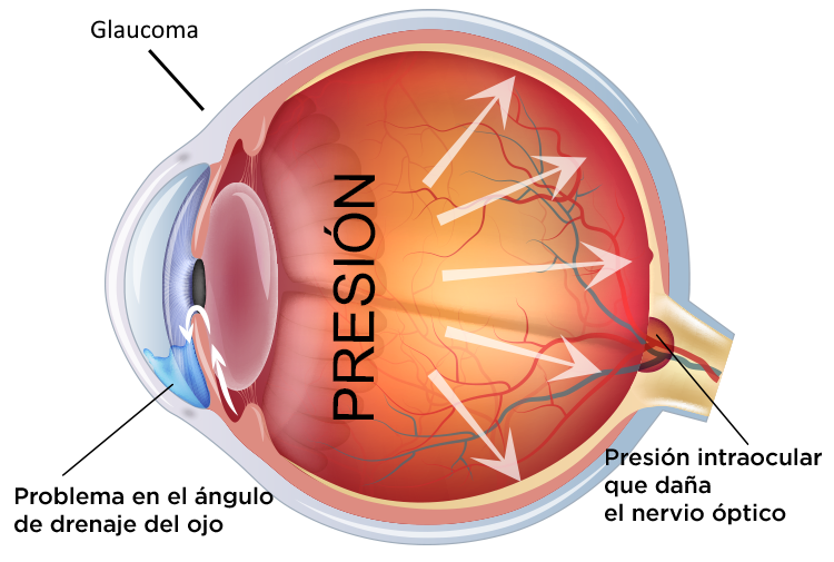 GLAUCOMA y la presión intracular.