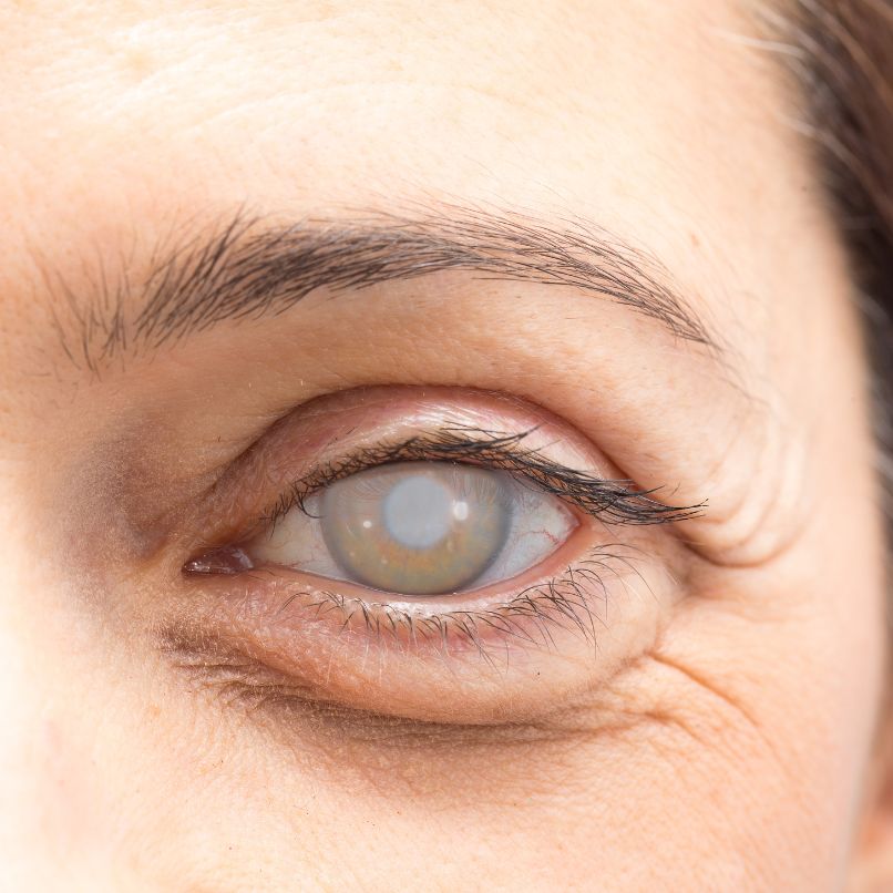 Cataratas en Tijuana con la doctora Marina Ramírez Alfaro