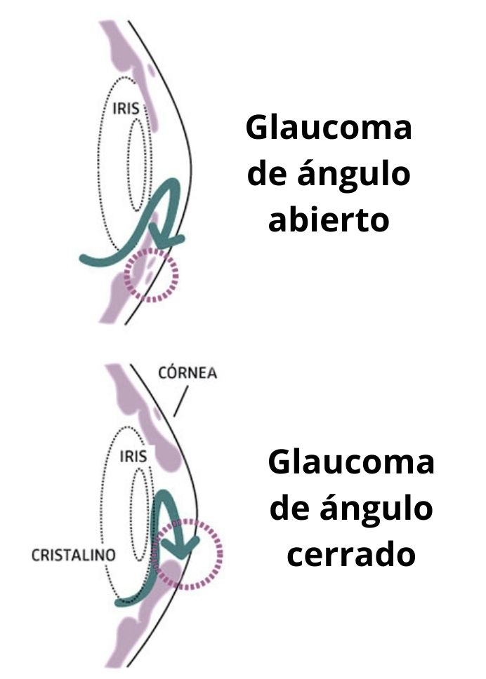 glaucoma de ángulo abierto y cerrado