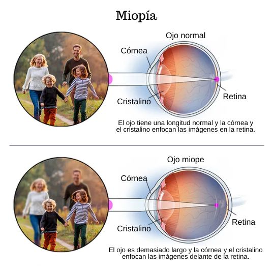 Miopía