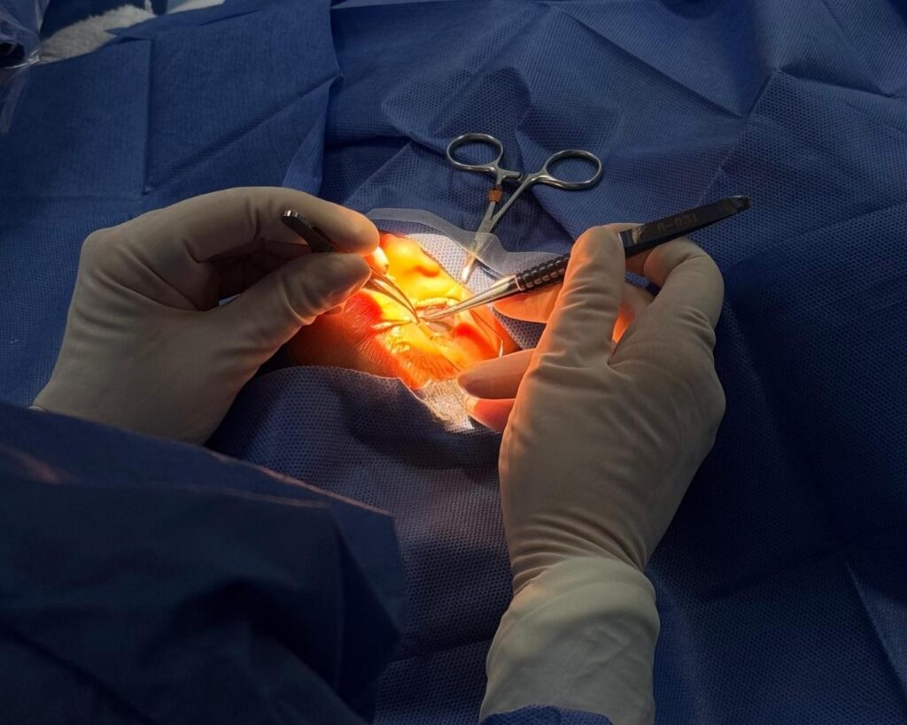 ¿Cómo se realiza la cirugía LASIK? Tijuana