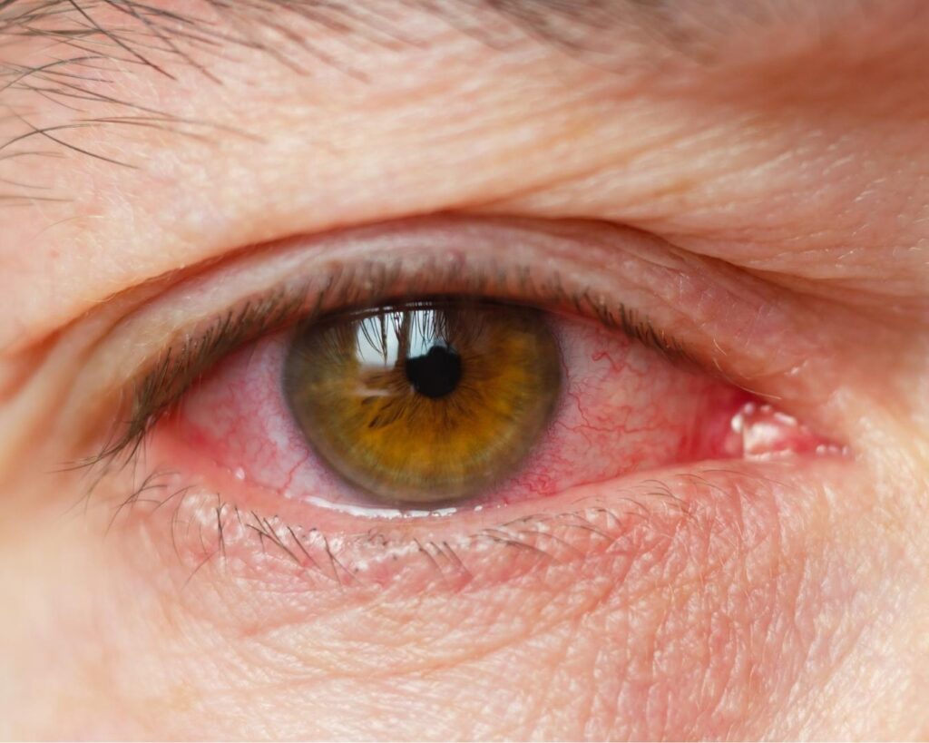 ojo rojo por uveítis