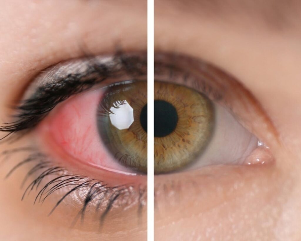 comparación ojo sano vs ojo con uveítis