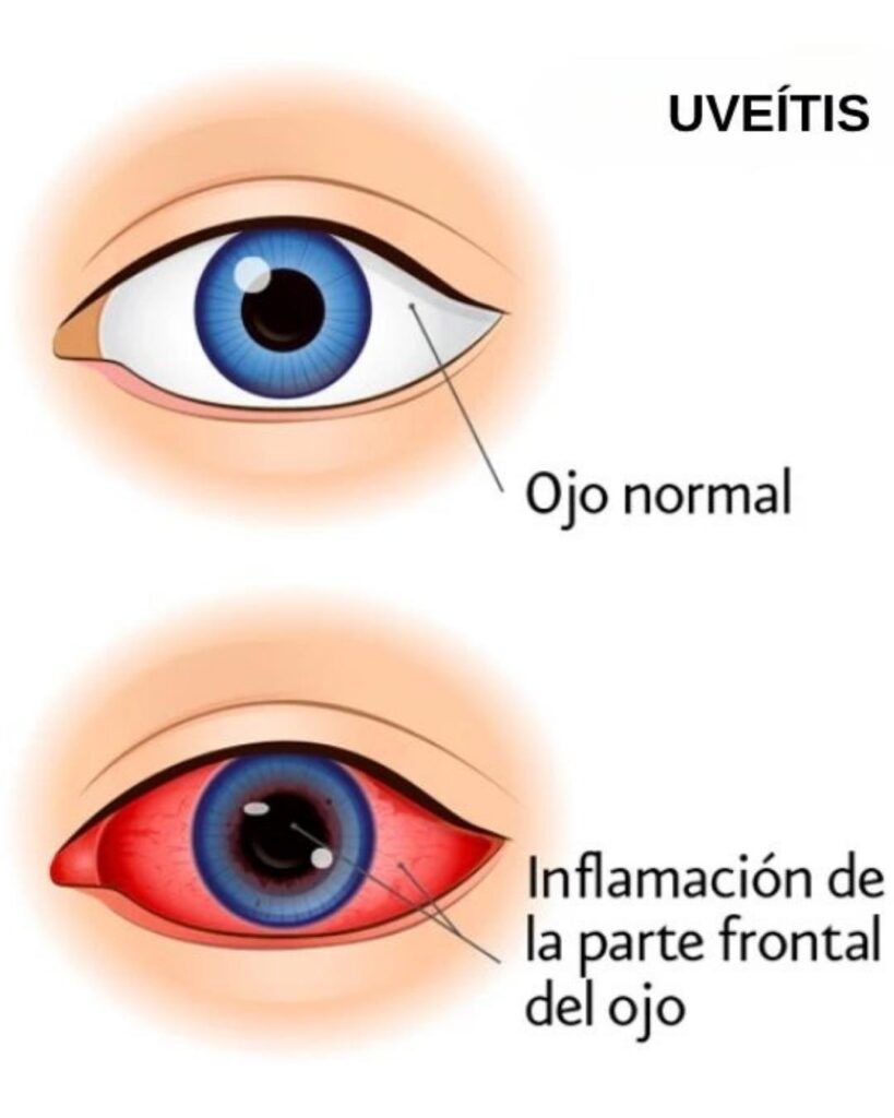 uveítis, ojo normal vs inflamación del ojo