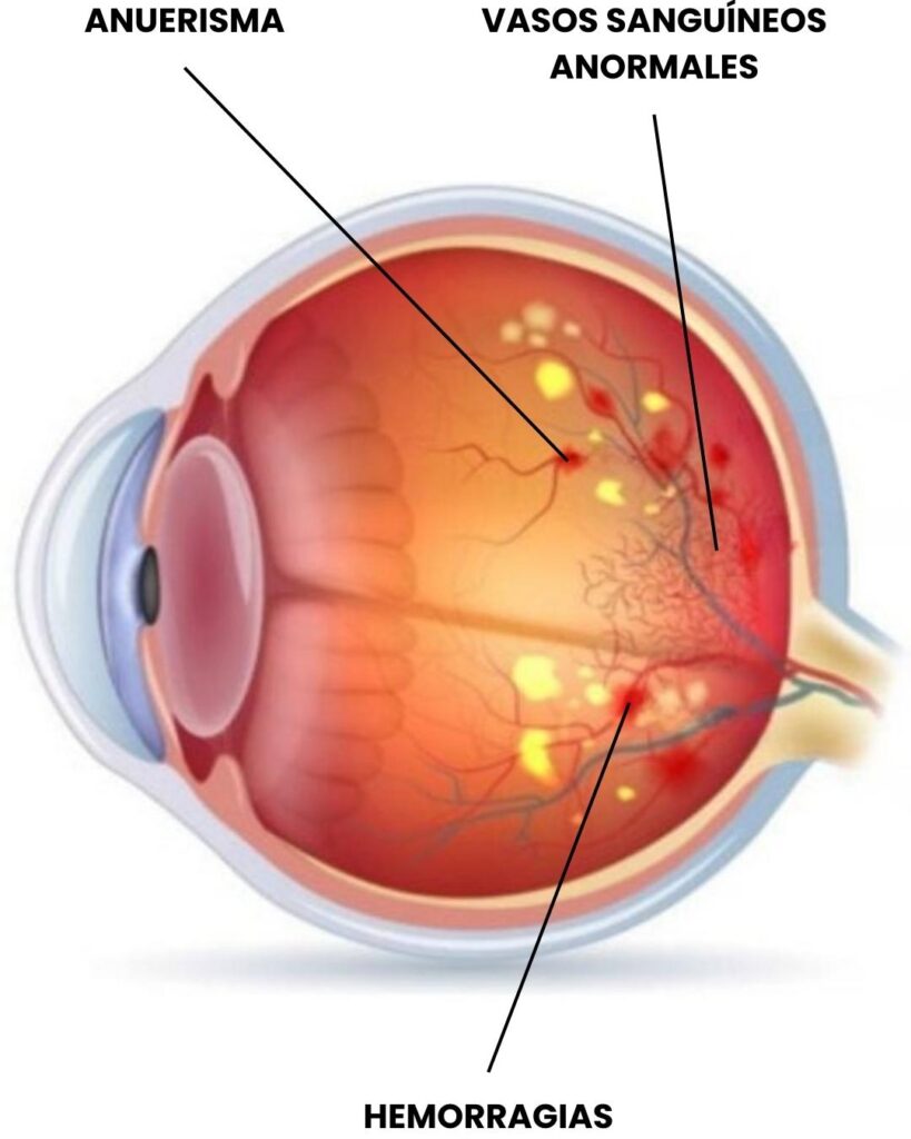 diagrama de Retinopatía diabética en Tijuana