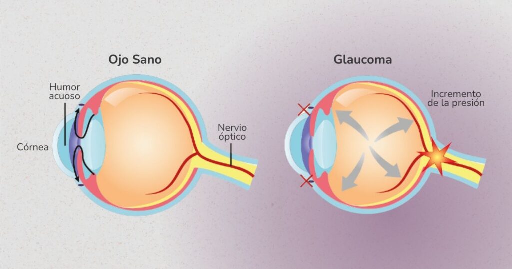 enfermedad ocular que daña el nervio óptico